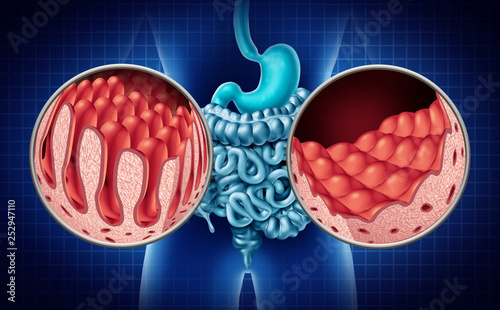 Foto Celiac Intestine Disease