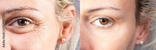 Female eyes with and without eye bag before and after cosmetic treatment