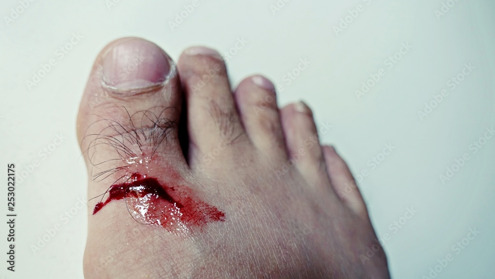 Toe is wound due to an accident without being careful, The toes were wounded with blood flowing, close up part of human body got accident concept Toe is wound due to an accident without being careful, The toes were wounded with blood flowing, close up part of human body got accident concept