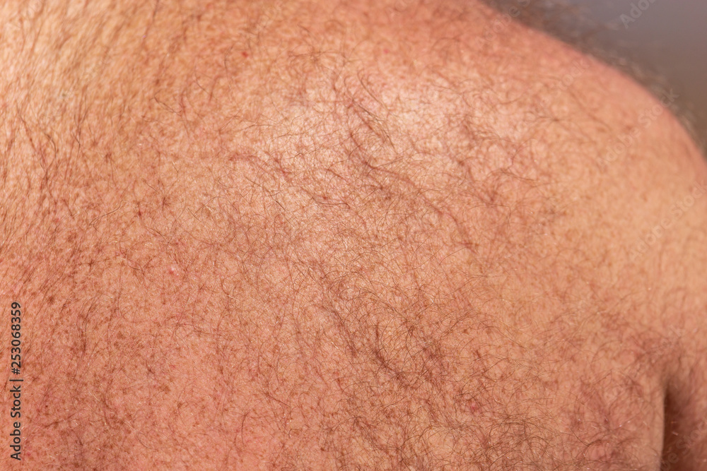 Fototapeta premium Hair grows on the back of a man