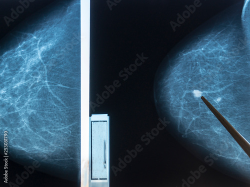 Mammography. The doctor examines pictures of a patient with fibroadenomatosis. photo