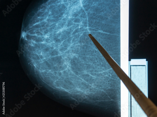 Mammography. The doctor examines pictures of a patient with fibroadenomatosis.