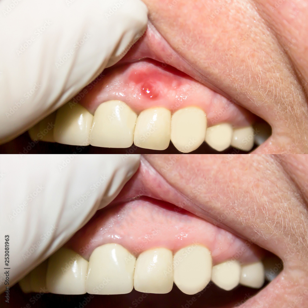 Periodontitis. Inflammatory process in the gum area. The doctor