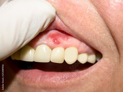 Periodontitis. Inflammatory process in the gum area. The doctor examines the oral cavity. Preliminary examination of the dentist.