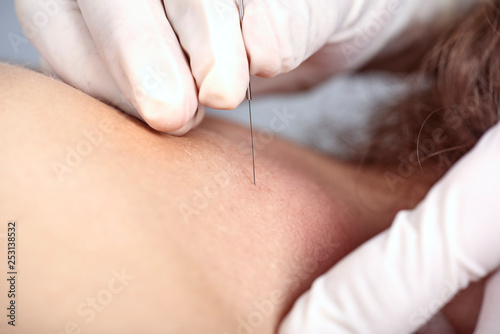 Chiropractor doing dry needling  closeup of a needle and hands. Physiotherapist  osteopath  manual therapy  acupressure. Acupuncture  alternative medicine.