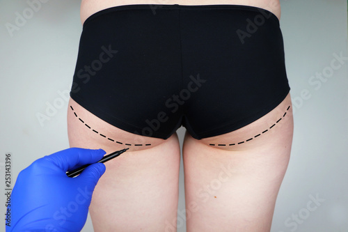 Plastic surgery: femoroplasty, cruroplasty, buttocks endoprosthetics, gluteoplasty. Patient on consultation with a plastic surgeon photo