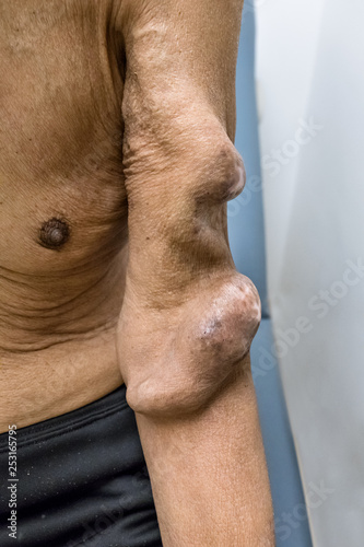 Left arm arteriovenous fistula in a patient with stage 4 renal failure in hemodialysis photo