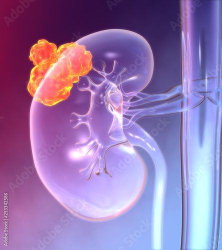 Kidney cancer, colorful medically 3D illustration photo