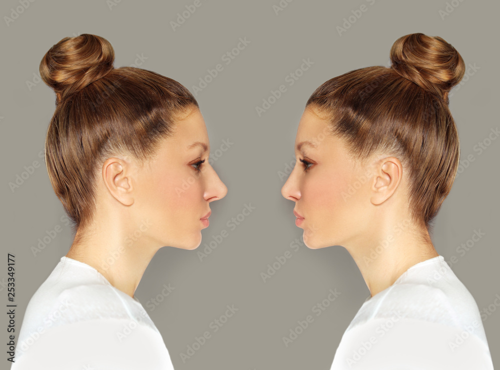 Rhinoplasty.Before and after Rhinoplasty.Before and after