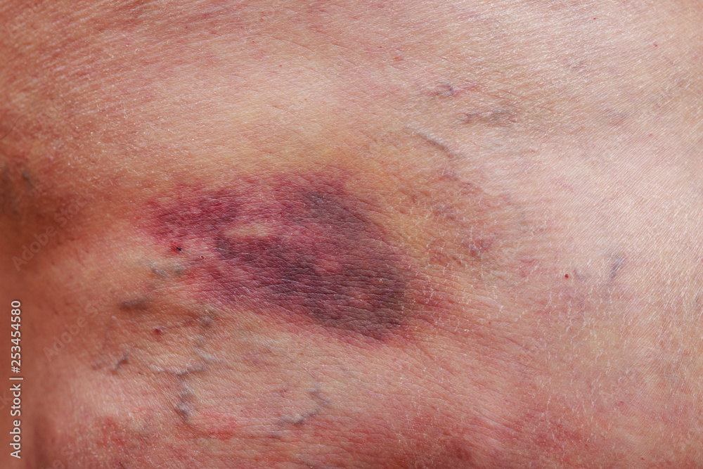 The varicose veins