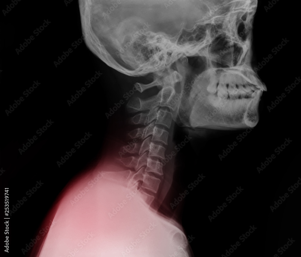 x ray shoulder pain Stock Photo Adobe Stock