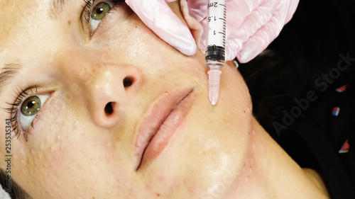 Young woman getting biorevitalization of the face procedure.and face lifting