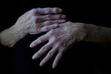 elderly woman's arthritic hands arthritis and aging