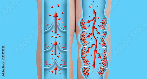 Tableau sur toile Varicose veins on a female senior legs