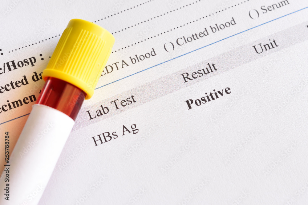 Hepatitis B Virus Positive Test Result With Blood Sample Tube Stock ...