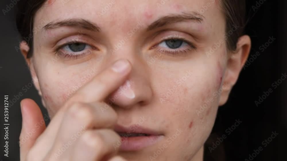 Beautiful girl with not smooth skin smears pimples on her face Beautiful girl with not smooth skin smears pimples on her face