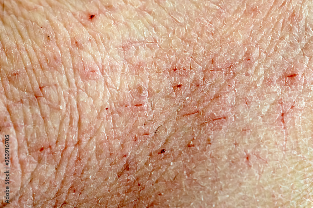Fototapeta premium Damaged dry human skin texture macro shot
