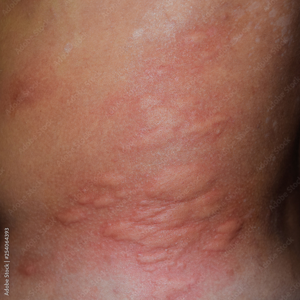 Allergy skin back and sides. Allergic reactions on the skin in the form of swelling and redness Allergy skin back and sides. Allergic reactions on the skin in the form of swelling and redness