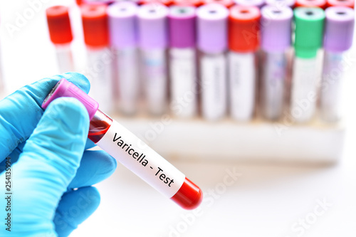 Blood sample tube for chickenpox or varicella virus test photo