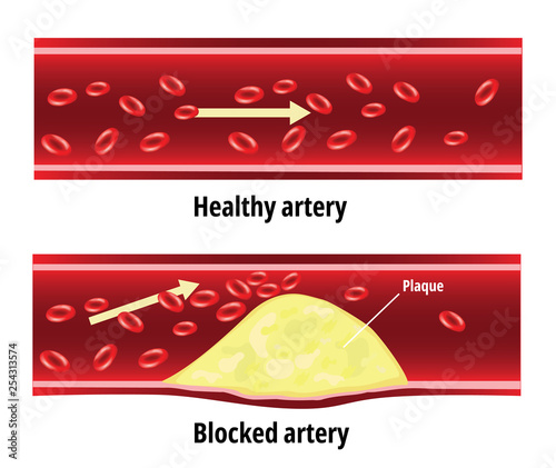 Blocked artery, fat stuck in the blood artery, cholesterol