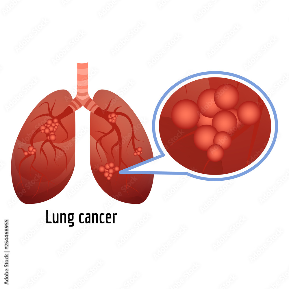 Lung cancer icon. Cartoon of lung cancer vector icon for web design  isolated on white background Stock Vector | Adobe Stock