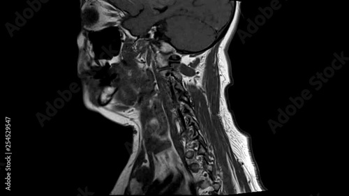 Magnetic resonance imaging of human spine. MRI of Lumbar & Thoracic spine. CT Computed tomography scans of human spine on a ultrasound computer monitor