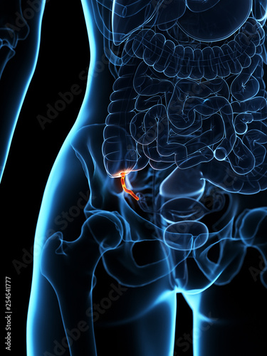 3d rendered medically accurate illustration of an inflamed appendix