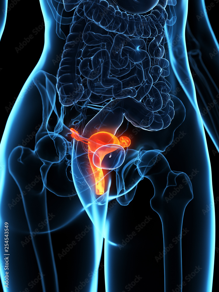 3d rendered medically accurate illustration of a diseased uterus 3d rendered medically accurate illustration of a diseased uterus