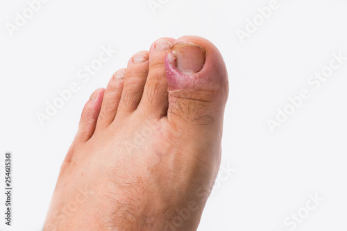 Close up of ingrown toenail is Inflamed fingernails photo