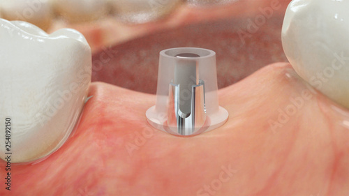 Tableau sur toile Inseriertes Implantat mit Prep-Cap (transparent dargestellt) zum Ausgleich von E