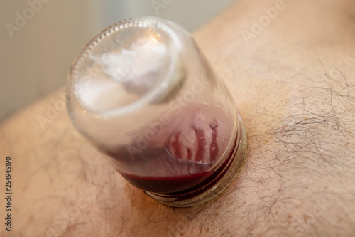 Healing bloodletting, hijama or phlebotomy. Hajam master conducts cupping therapy on a young woman. Islamic medicine photo