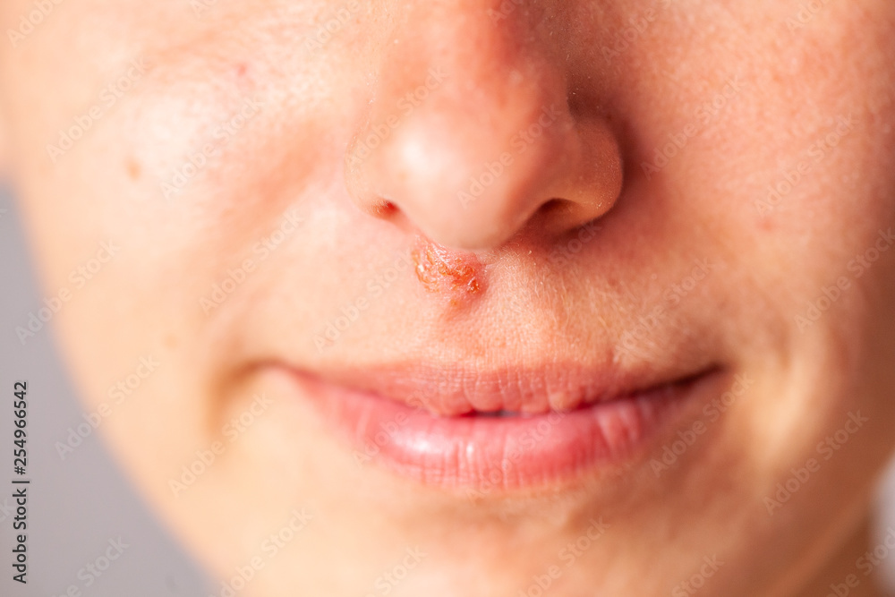 Obraz premium herpes under the nose
