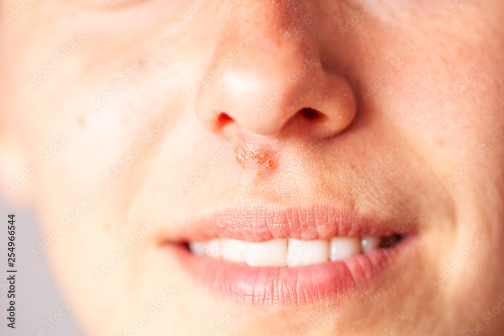 Obraz premium herpes under the nose