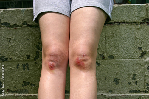 Childs Skinned Knees in Summer