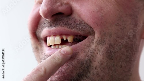 Man open his mouth and points by finger at his bad broken teeth close-up on a white background.