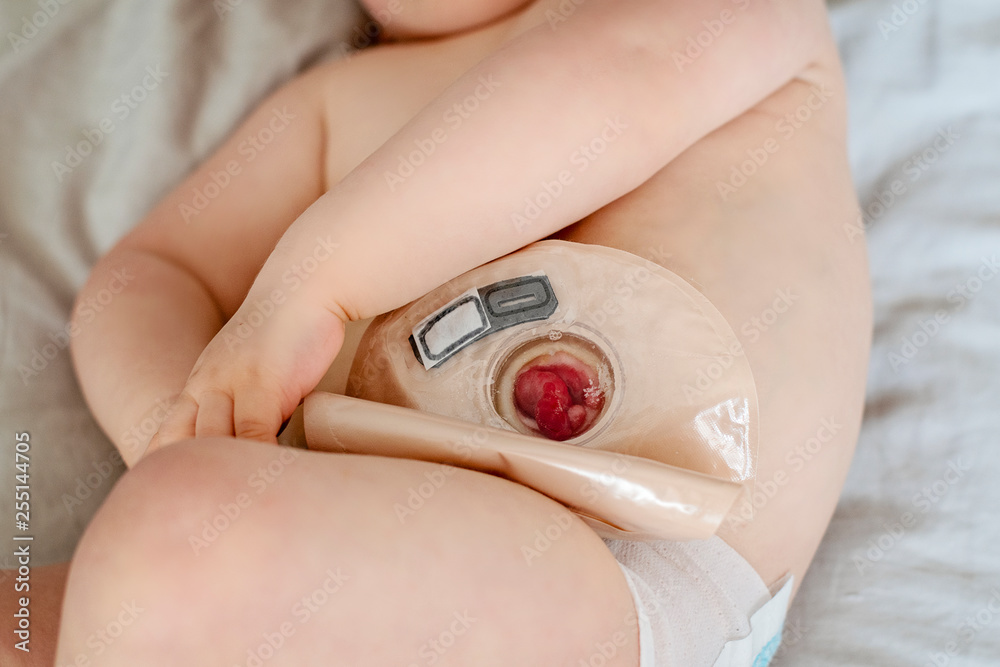 Close-up top view on transparent colostomy pouch attached to baby patient.  Ostomy bag with filter. Colostomy surgery. Medical theme. Stock Photo
