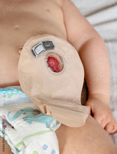 Close-up top view on transparent colostomy pouch attached to baby patient. Ostomy bag with filter. Colostomy surgery. Medical theme. photo
