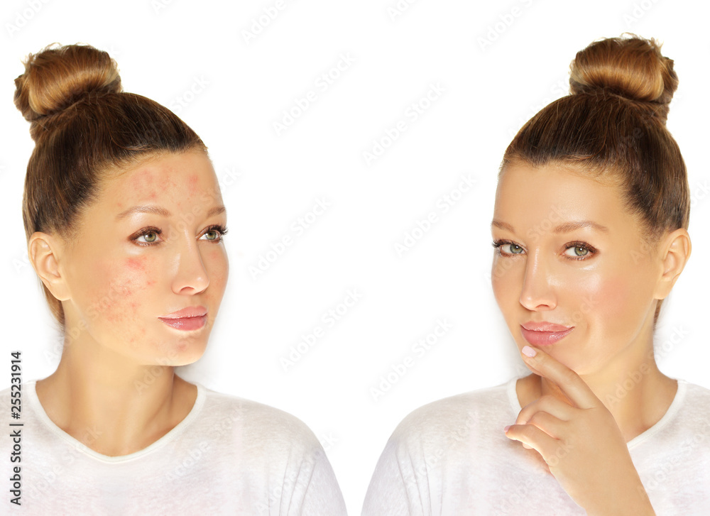 Post-Acne Marks /Treating Acne Scars.Acne Scar Removal Post-Acne Marks /Treating Acne Scars.Acne Scar Removal