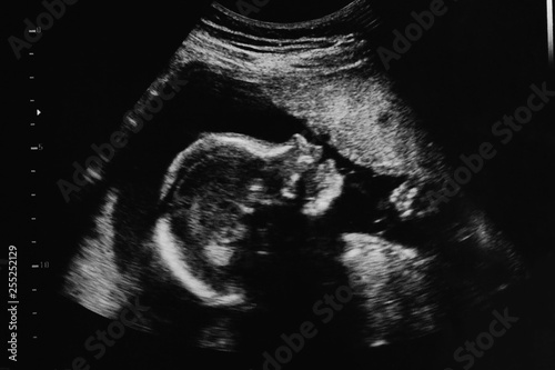 Ultrasound photo of unborn baby in mother's womb, closeup view