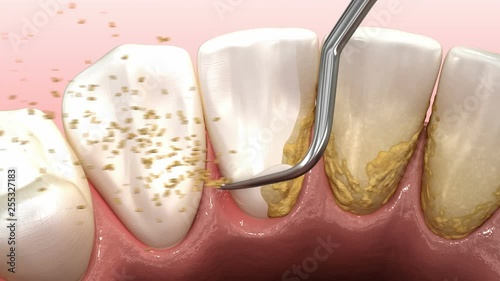 Oral hygiene: Ultrasonic teeth cleaning machine removing calculus and plaque. Medically accurate 3D animation of human teeth treatment