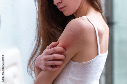 Young woman suffering from itching on her skin and scratching an itchy place. Allergic reaction to insect bites, dermatitis, food, drugs. Health care concept. Allergy rash photo