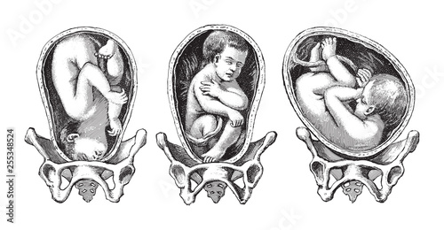 Positions child in womb / vintage illustration from Die Frau als hausarztin 1911