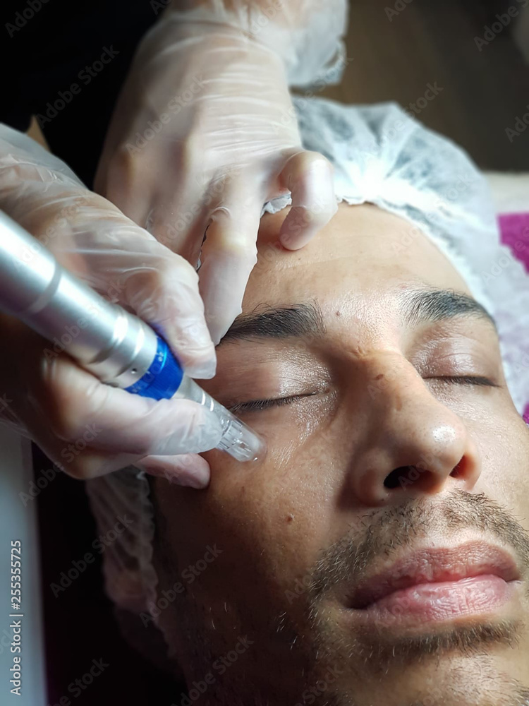 microneedling facial microneedling facial