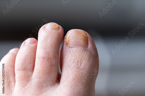 Fungal nail infection on human foot.