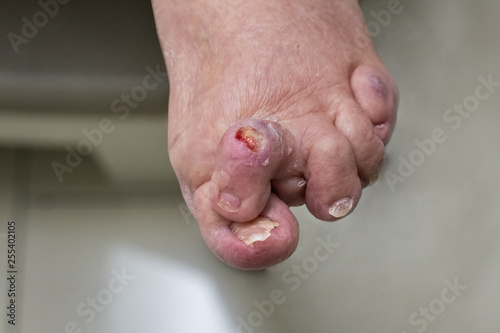 Fotografía Hammer toe and bunion with pressure ulcer
