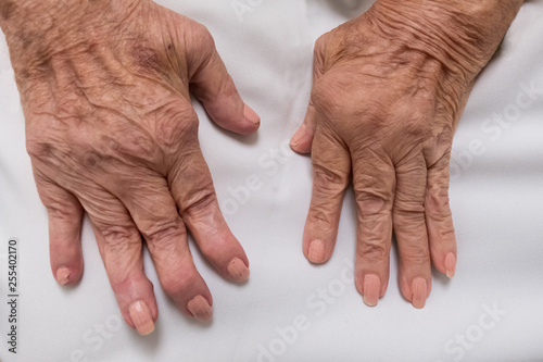 Rheumatoid Arthritis on female hands photo