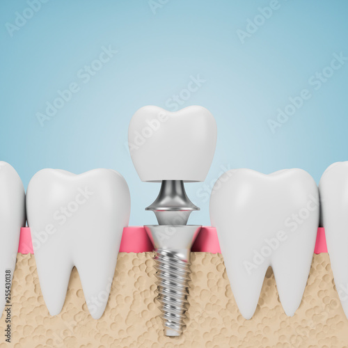 Teeth with implant screw, blue background photo