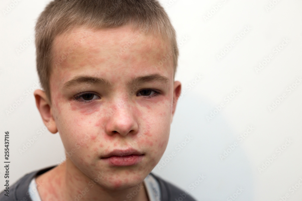 Fototapeta premium Portrait of sick sad boy child suffering from measles or chicken pox with bumps all over face. Contagious child diseases and treatment.