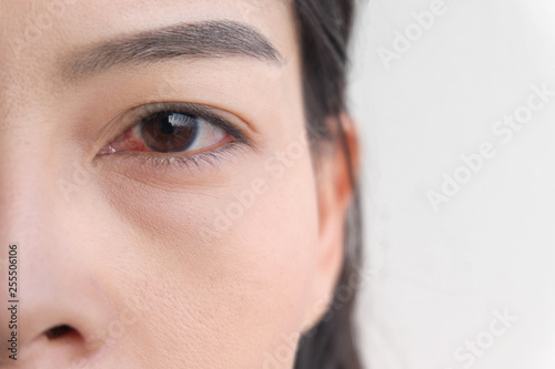 red eye. conjunctivitis or irritation of sensitive eyes.