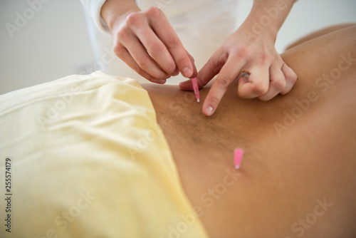 close up detail of acupuncture needles in back neck